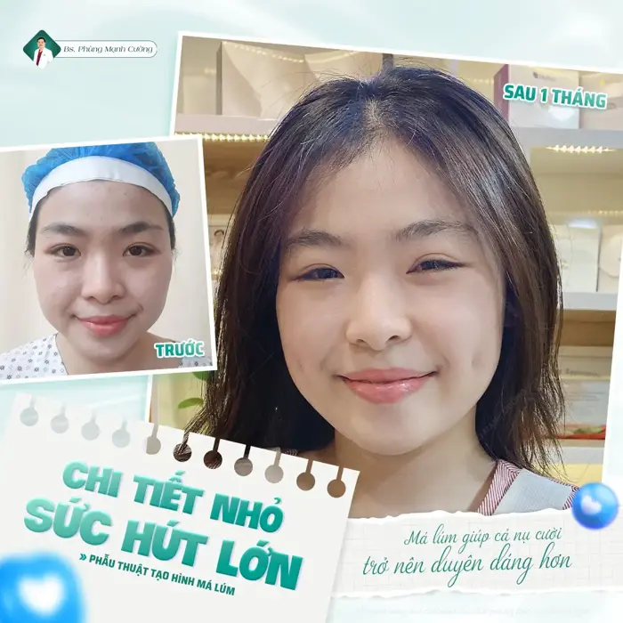 Tạo Má Lúm Đồng Tiền Là Gì? Chi Phí Bao Nhiêu?