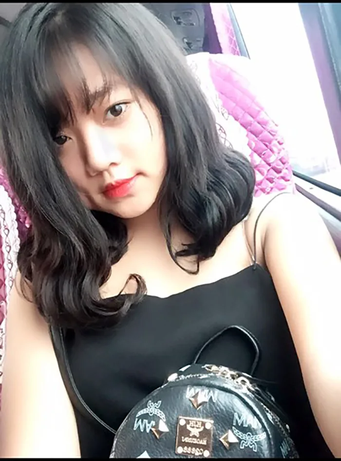 Muốn làm duyên bằng má lúm đồng tiền nhân tạo, cô gái trẻ bị áp-xe, má sưng  như quả trứng