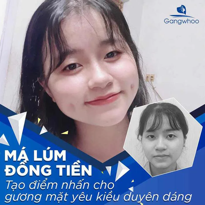 Tạo Má Lúm Đồng Tiền Ở Đâu Đẹp?