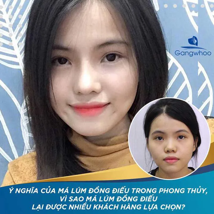Tạo Má Lúm Đồng Tiền Ở Đâu Đẹp?