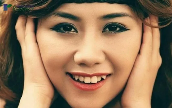 Răng khểnh là gì? Người răng khểnh cười sao cho đẹp