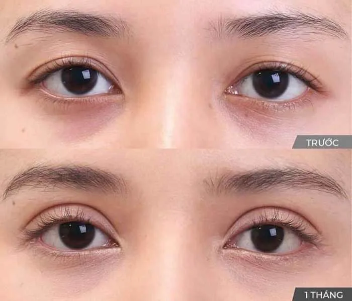 Cắt Mắt 2 Mí Ở Đâu Đẹp? Bí Quyết Chọn Địa Chỉ Uy Tín - Tạo Mắt 2 Mí