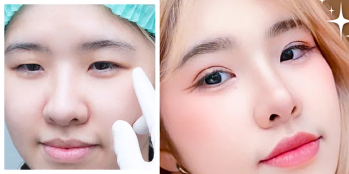 Mắt một mí là đẹp hay xấu? Có ảnh hưởng gì không? - Keangnam Korea