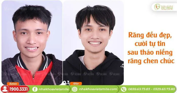 Gương mặt hào hòa hơn sau tháo niềng - KH. Bùi Xuân Trung 4060