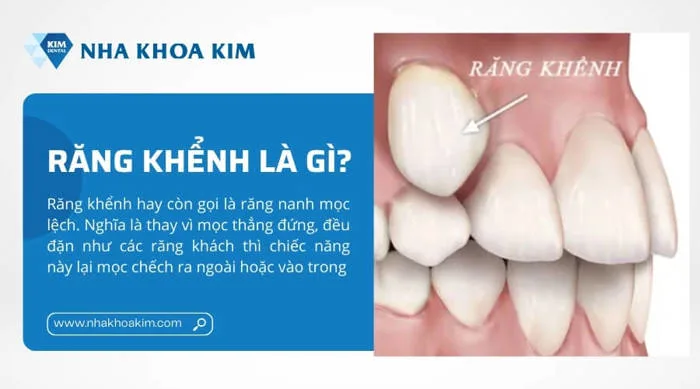 Răng khểnh là đẹp hay xấu? Các kiểu răng khểnh đẹp