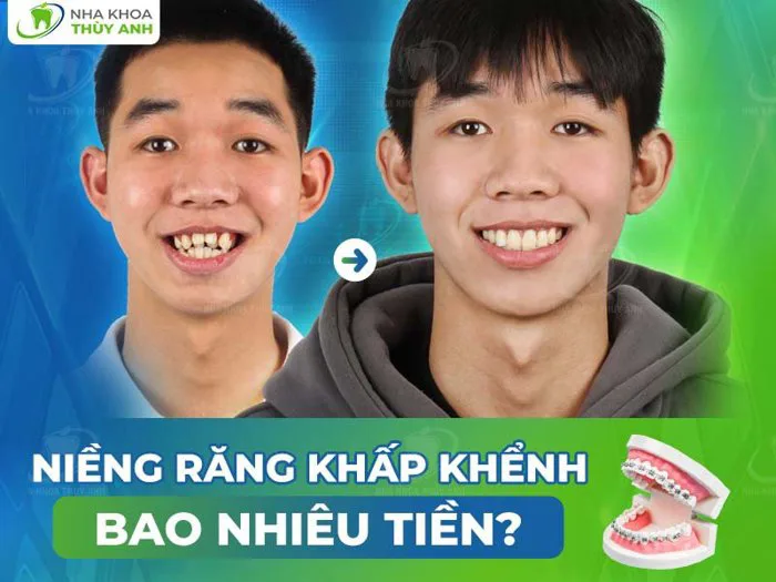 Niềng răng khấp khểnh bao nhiêu tiền? [Chi phí tháng 8.2026]