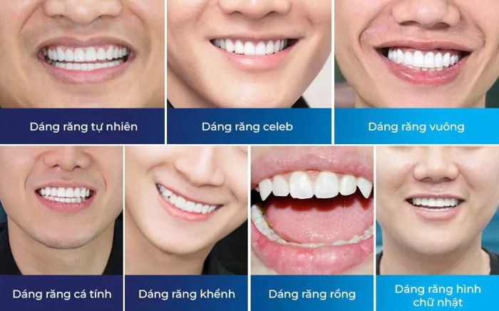 Top 7 dáng răng sứ nam đẹp được ưa chuộng nhất hiện nay - Saostar.vn