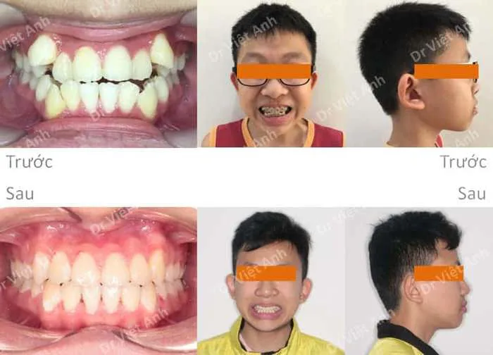 Hình ảnh Niềng Răng: Hình ảnh niềng răng thành công một hàm răng siêu khấp  khểnh lộn xộn - Ca 10 - Bs Việt Anh